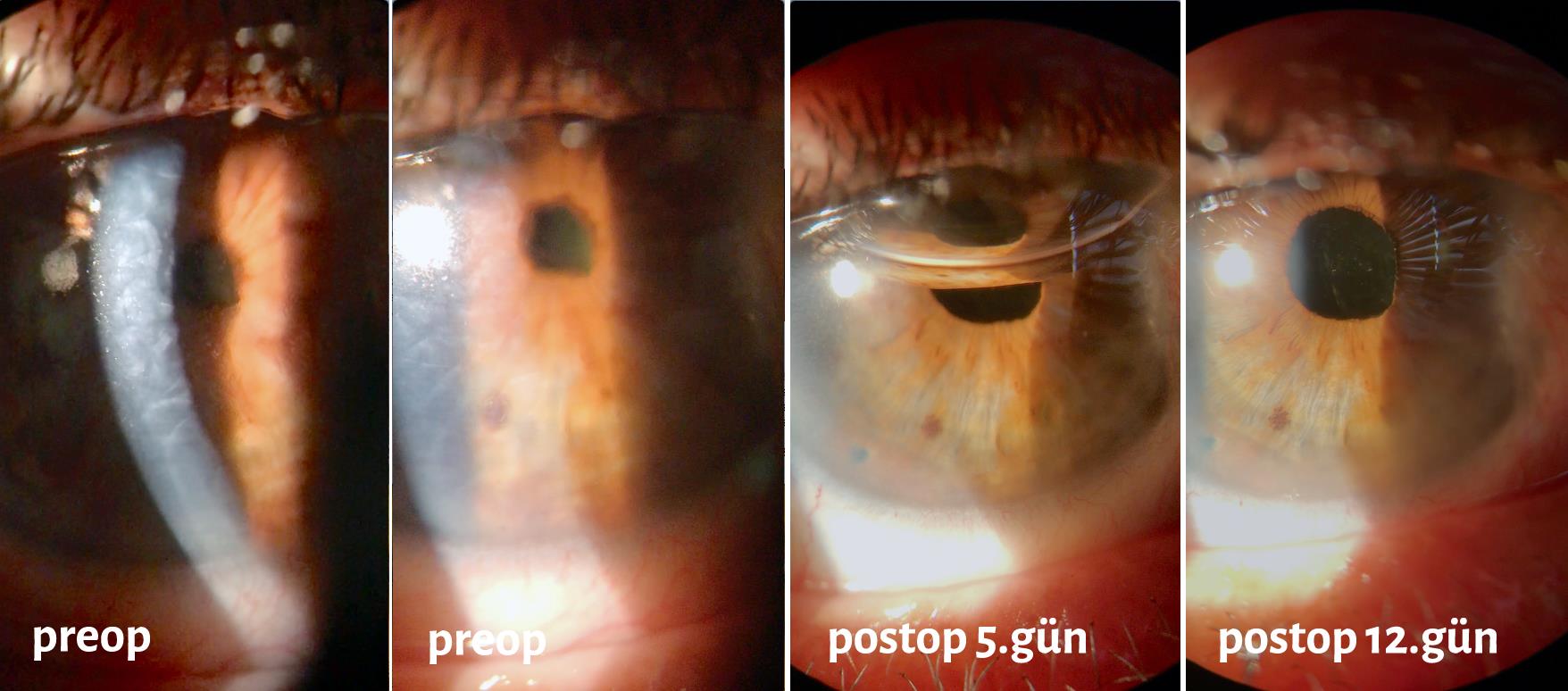 'Corneal Transplantation with Closed Method' Performed in Our Hospital